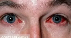 صفر تا صد کرونای چشمی | این افراد بیشتر مراقبت کنند