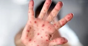 هشدار بیماری | اتباع افغان و پاکستان سوغاتی تازه آوردند !