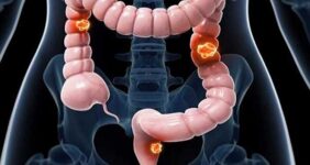 عوامل ابتلا به سرطان روده بزرگ را بشناسیم