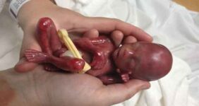 سقط جنین؛ از «صنعت پول‌های سیاه» تا عوارض جبران‌ناپذیر جسمی و روانی