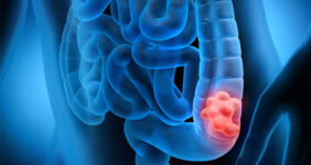 مصرف مشروبات الکلی خطر ابتلا به سرطان روده بزرگ را افزایش می‌دهد