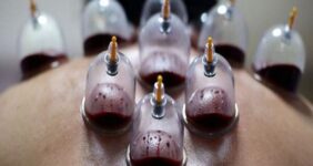 حجامت توسط افراد غیر متخصص خطرناک است حجامت توسط افراد غیر متخصص خطرناک است
